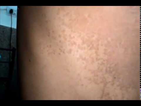 Pityriasis Versicolor  Tinea versicolor  YouTube