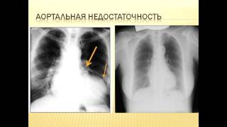 Рентгенологическая картина аортальной формы сердца