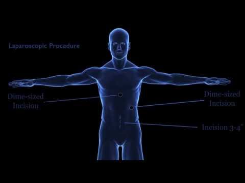 What is Minimally Invasive Colon Cancer Surgery?