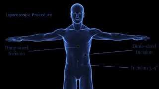 What is Minimally Invasive Colon Cancer Surgery?
