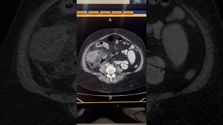 Perforated Appendicitis with Abscess CT #shorts