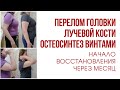 Восстановление локтевого сустава после перелома.