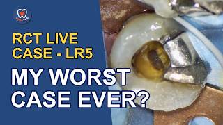 EP134# This Looks Like My Worst Root Canal. It's One of My Best.