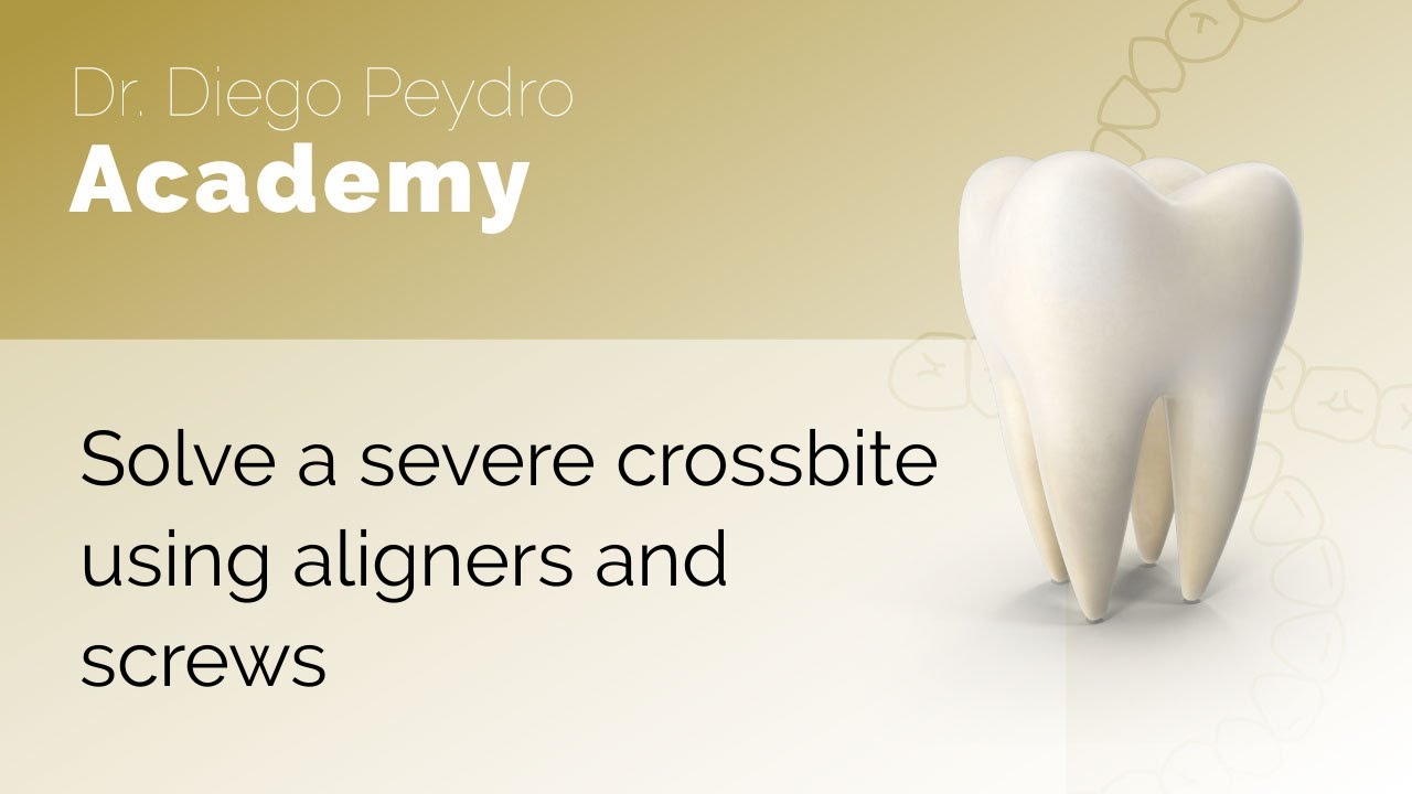 Planification for severe Crossbite   using aligners