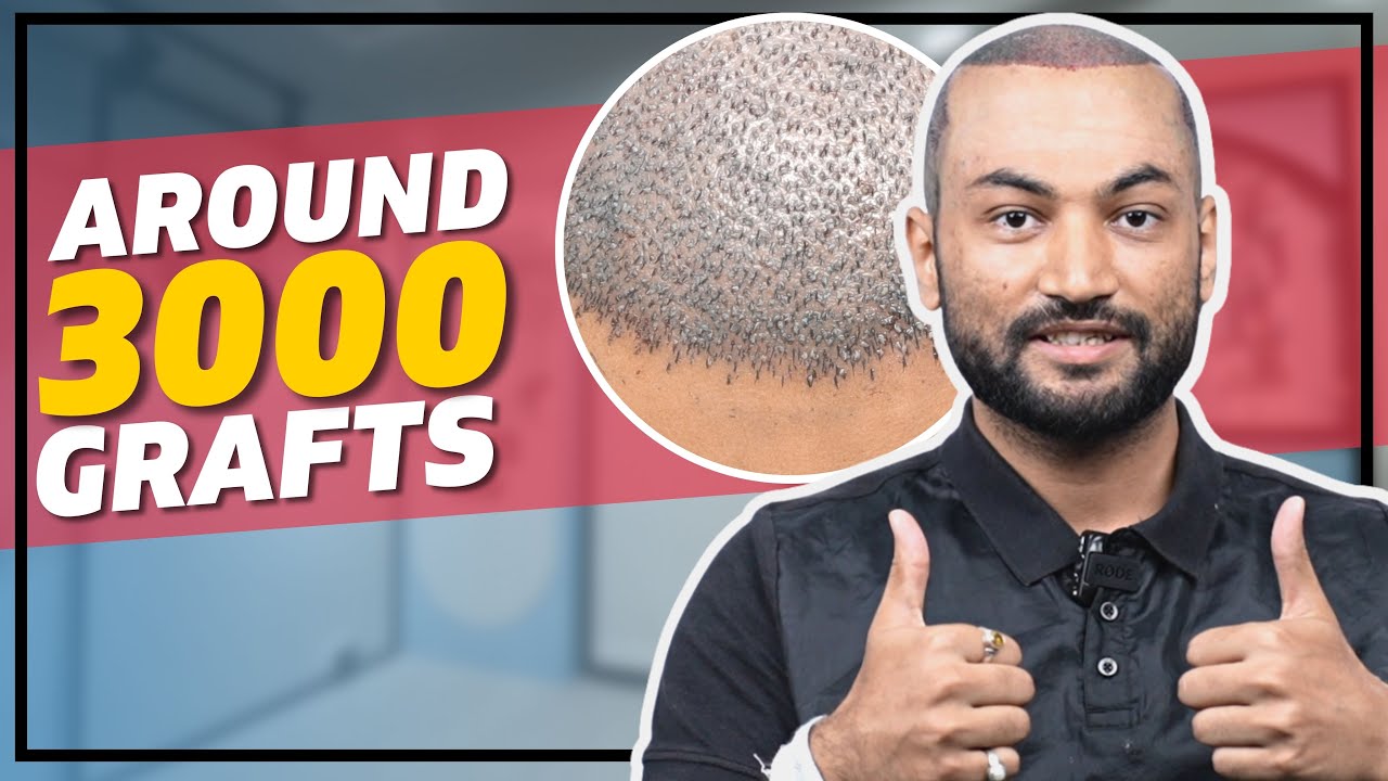 Hair Transplant in Bangalore | Best Results & Cost of Hair Transplant ...