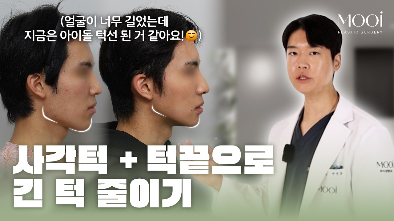 긴 턱, 사각턱+턱끝 수술로 얼마나 달라질까?|무이성형외과 #사각턱수술 #턱끝수술 #긴턱