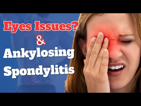 How is Ankylosing Spondylitis Affecting the Eyes?