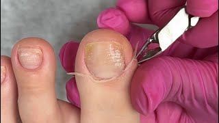 Cutilagem do dedão do pé 🤤