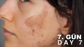 Acnelyse Cream Tretinoin