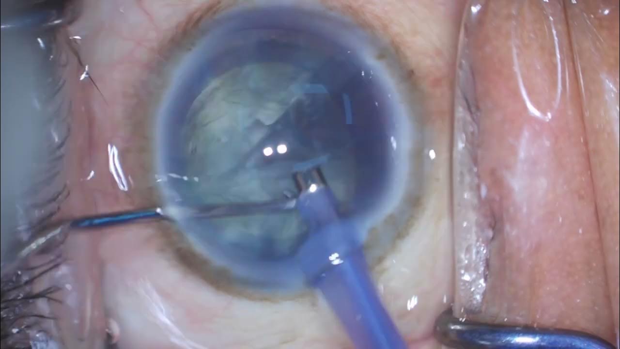 Routine Cataract Surgery Using Aurolab Vivid EDOF Lens YouTube routine-cataract-surgery-using-aurolab-vivid-edof-lens-youtube