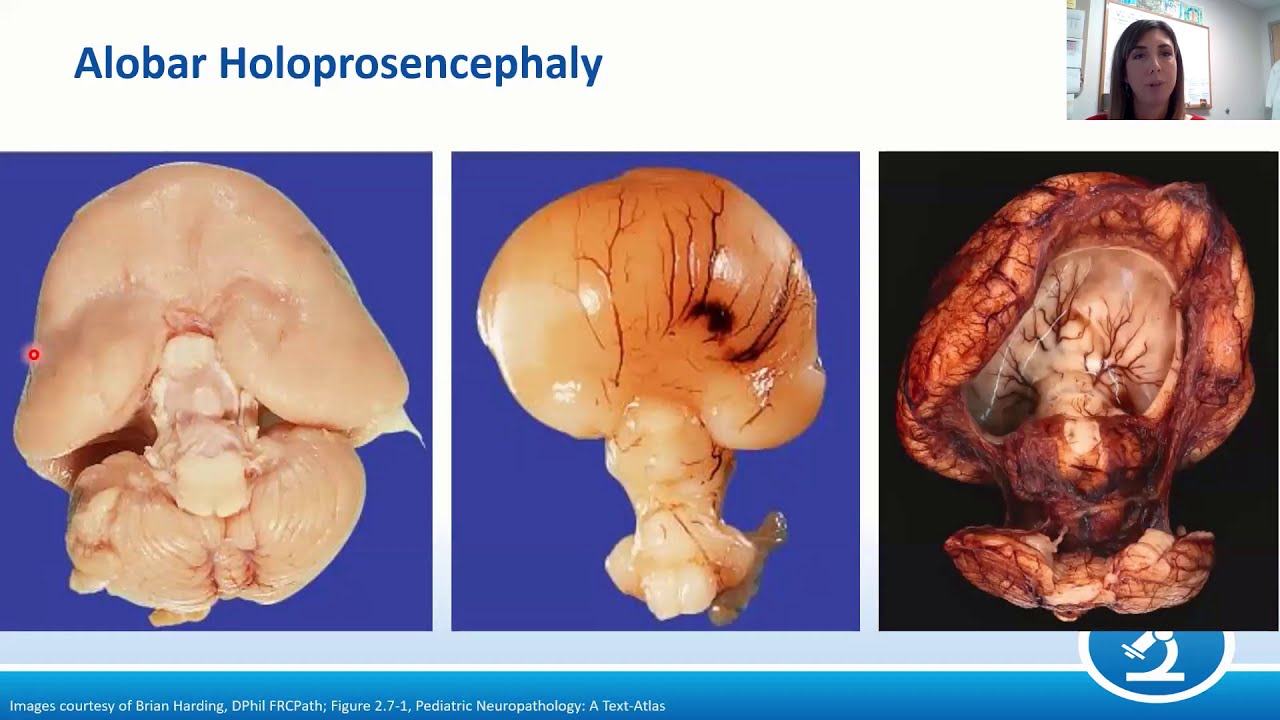 Pediatric Neuropathology