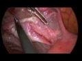 Total laporscopic hysterectomy