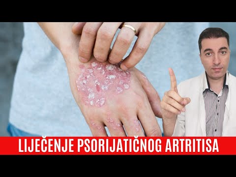 Liječenje PSORIJATIČNOG ARTRITISA