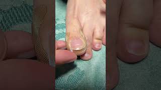 Toe Nail Fixer| Ingrown Toenail Cleaning & Care #ToenailFix #NailCare #FootCare #PedicureClean