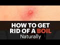 "Boils: The Hidden Heat Beneath Your Skin".