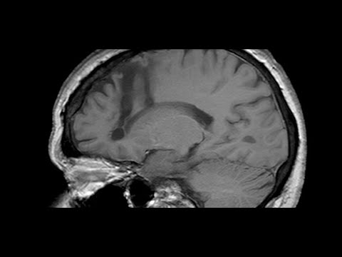 Wideo: Mieszany Guz Neuronowo-glejowy W Płacie Skroniowym Niemowlęcia: Opis Przypadku
