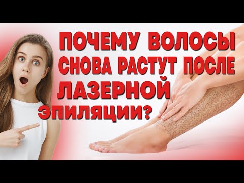 ПОЧЕМУ ВОЛОСЫ СНОВА РАСТУТ ПОСЛЕ ЛАЗЕРНОЙ ЭПИЛЯЦИИ