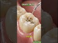 What Happens If You Ignore a Cavity?  (Shocking Truth)