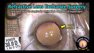 CataractCoach 1136: refractive lens exchange RLE surgery for high hyperopia