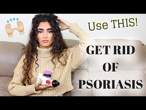 HOW TO GET RID OF PSORIASIS.. SERIOUSLY!