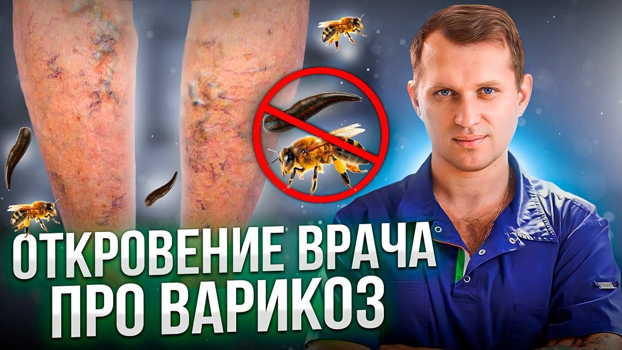 Как правильно ЛЕЧИТЬ ВАРИКОЗ? Честный ответ ФЛЕБОЛОГА! - YouTube