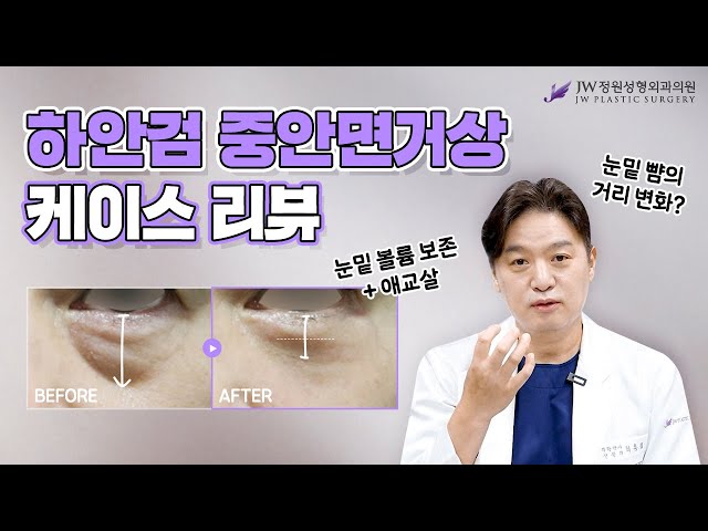 [할많하안검] 23년동안 눈밑수술에 집중해온 눈빛홍림의 하안검 중안면거상 케이스리뷰🙏💙