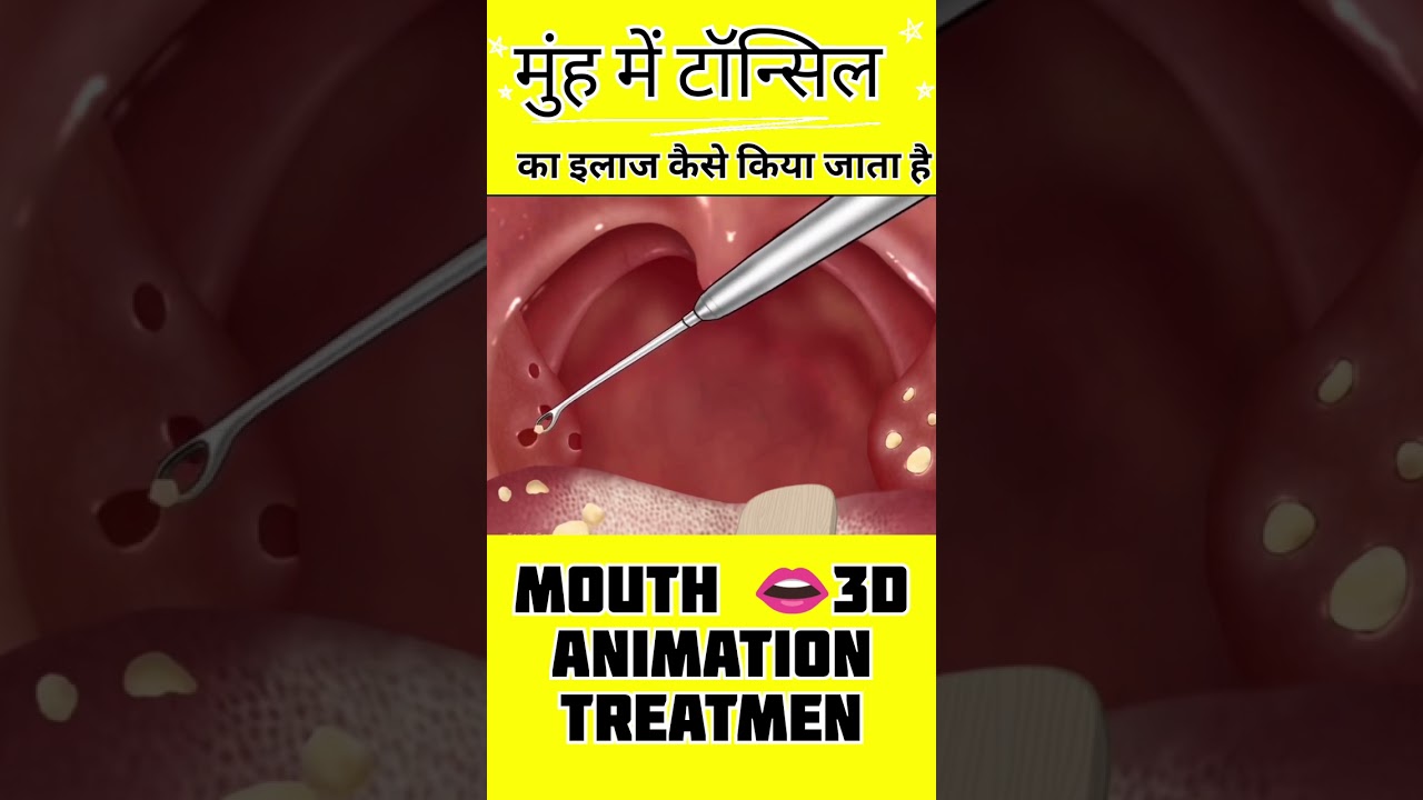 Παρακολούθηση मुंह में टॉन्सिल का इलाज कैसे किया जाता है?/ Mouth tonsil #tonsil#face treatment #full treatment στο YouTube Παρακολούθηση मुंह में टॉन्सिल का इलाज कैसे किया जाता है?/ Mouth tonsil #tonsil#face treatment #full treatment στο YouTube