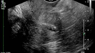 Saline Sonohysterogram endometrial polyp