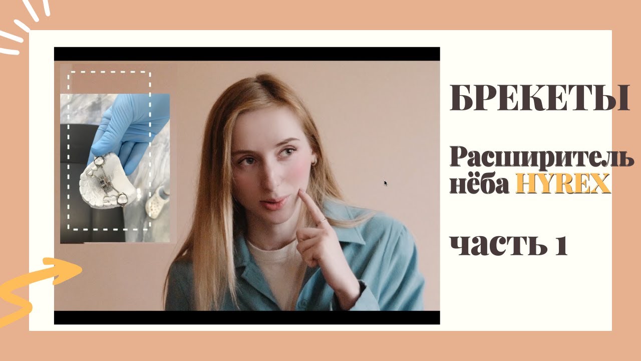 БРЕКЕТЫ во второй раз, расширитель неба Hyrex, боль, дикция