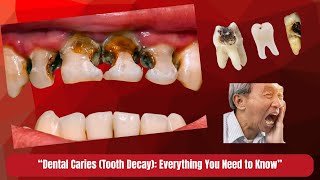 What Is Dental Caries? Tooth Decay Causes, Prevention & Cure Fix Your Smile