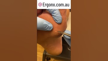 Ultimate Forefoot Corn Removal by Podiatrist 🚫 Pain Relief #FootCare #Podiatry