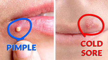 What's the Difference Between a Cold Sore and Pimple?