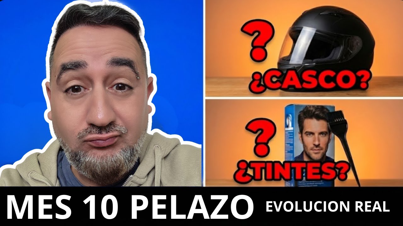 10 MESES INJERTO CAPILAR ¿Resultado Final o Sigue Creciendo?