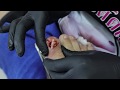 Ep_635 Ingrown nail removal 👣 อย่าดีดป้านะ 😅  (This video clip from thailand)
