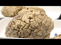 Medicina y salud: investigación en Alzheimer y Parkinsón. Facultad de Medicina UCLM