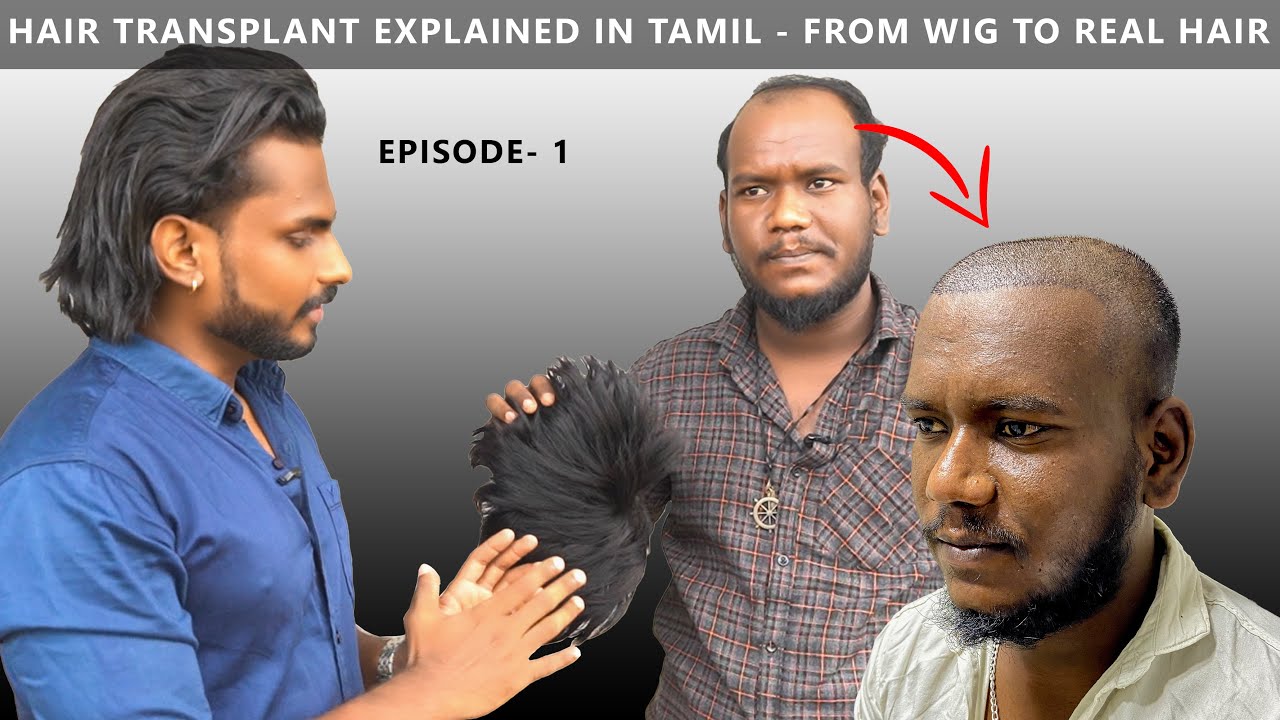 what is Hair-Transplantation explained by a Doctor in Tamil | | Episode 1 |  Men's Fashion Tamil - YouTube