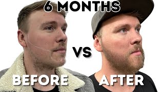 I regret my decision - Beard transplant 6 months on