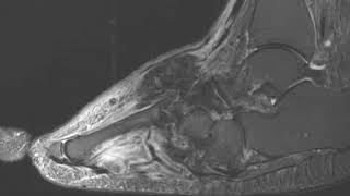 Musculoskeletal Trauma C4 Extensive Destruction (A). Gout. Inflammatory arthritis. Textbook