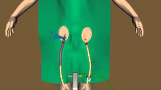 NovaLung cannulation animation