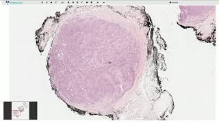 Glomus Tumor - Histopathology