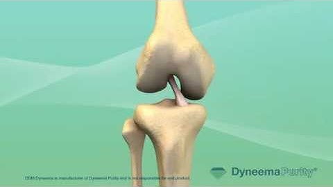 Anterior Cruciate Ligament (ACL) Repair - Medical Animation by Watermark