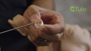 How TULA (Tubes Under Local Anesthesia) Works