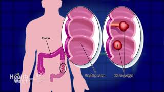 At Home Colorectal Cancer Screening Kits