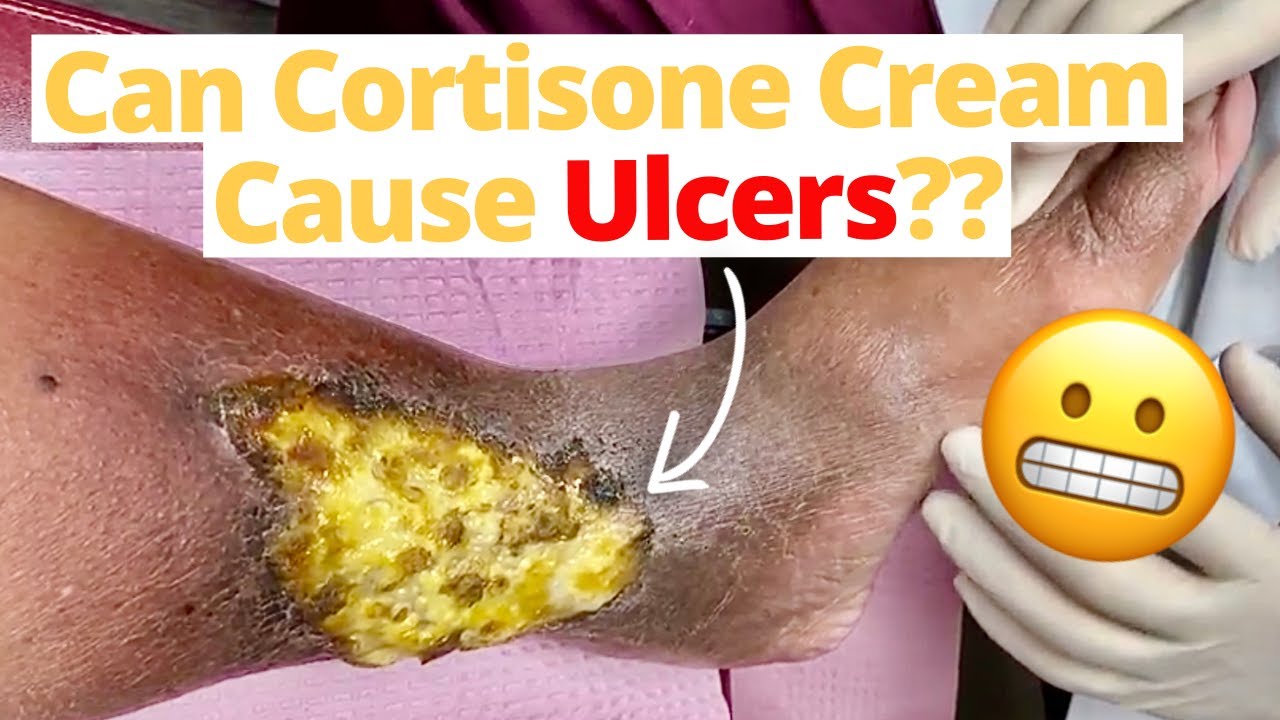 Can Cortisone Cream Cause Ulcers YouTube Can Cortisone Cream Cause Ulcers YouTube
