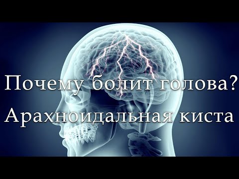 Видео: Вызывают ли арахноидальные кисты головные боли?