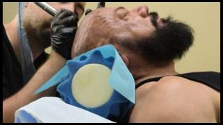 Scalp Micropigmentation Arizona - Dermimatch - Client Tony