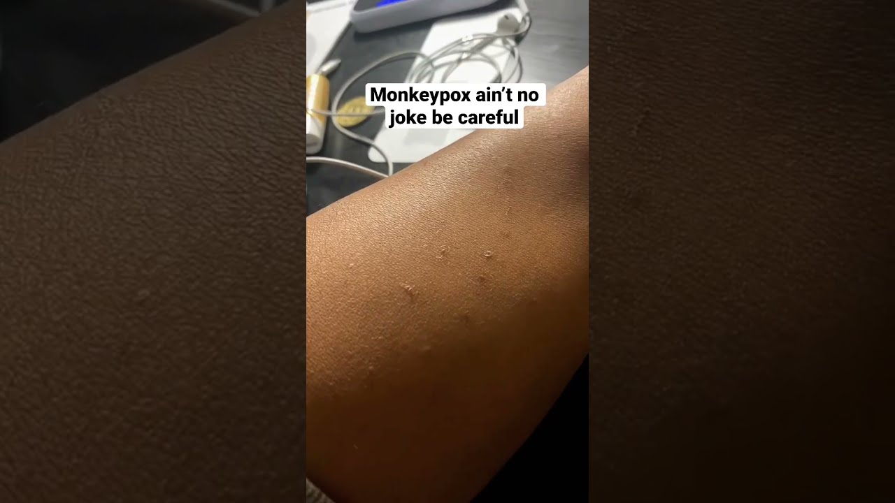 Monkeypox is no joke 🫡 
