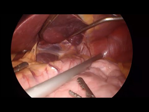 SADI-S Procedure with Standard Clamp® - video from Standard Bariatrics