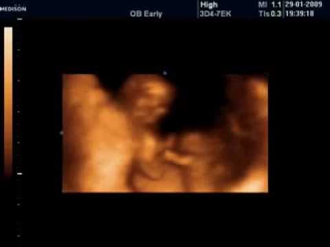 10 Haftalık Bebek Ultrason Görüntüsü - YouTube