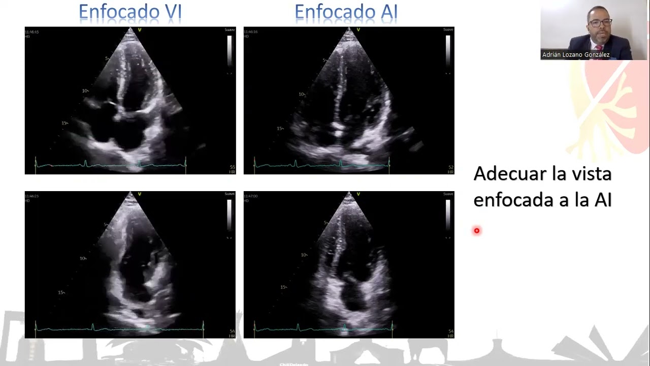 Strain de Aurícula Izquierda, Jornadas Aniversario de ASCARDIO 2023